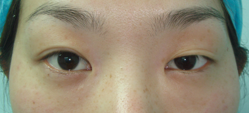 手術(shù)前,雙眼不對稱。