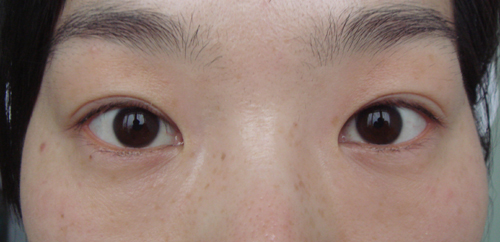 術(shù)后1年,雙眼對稱,重瞼弧度自然。